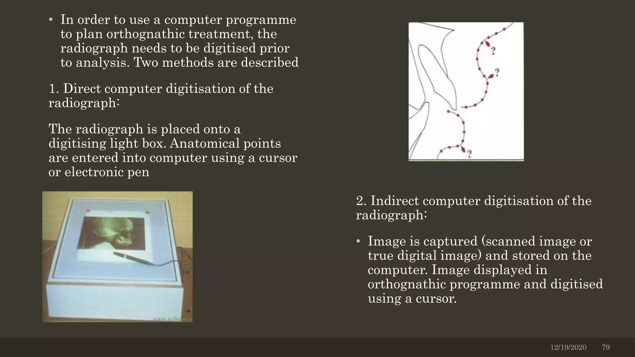 • In order to use a computer programme
to plan orthognathic treatment, the
radiograph needs to be digitised prior
to analysis. Two methods are described
1. Direct computer digitisation of the
radiograph:
The radiograph is placed onto a
digitising light box. Anatomical points
are entered into computer using a cursor
or electronic pen
2. Indirect computer digitisation of the
radiograph:
• Image is captured (scanned image or
true digital image) and stored on the
computer. Image displayed in
orthognathic programme and digitised
using a cursor.
12/19/2020 79
 