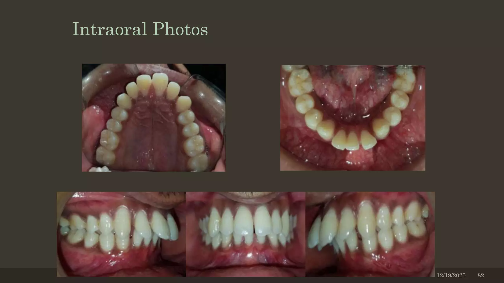 Intraoral Photos
12/19/2020 82
 