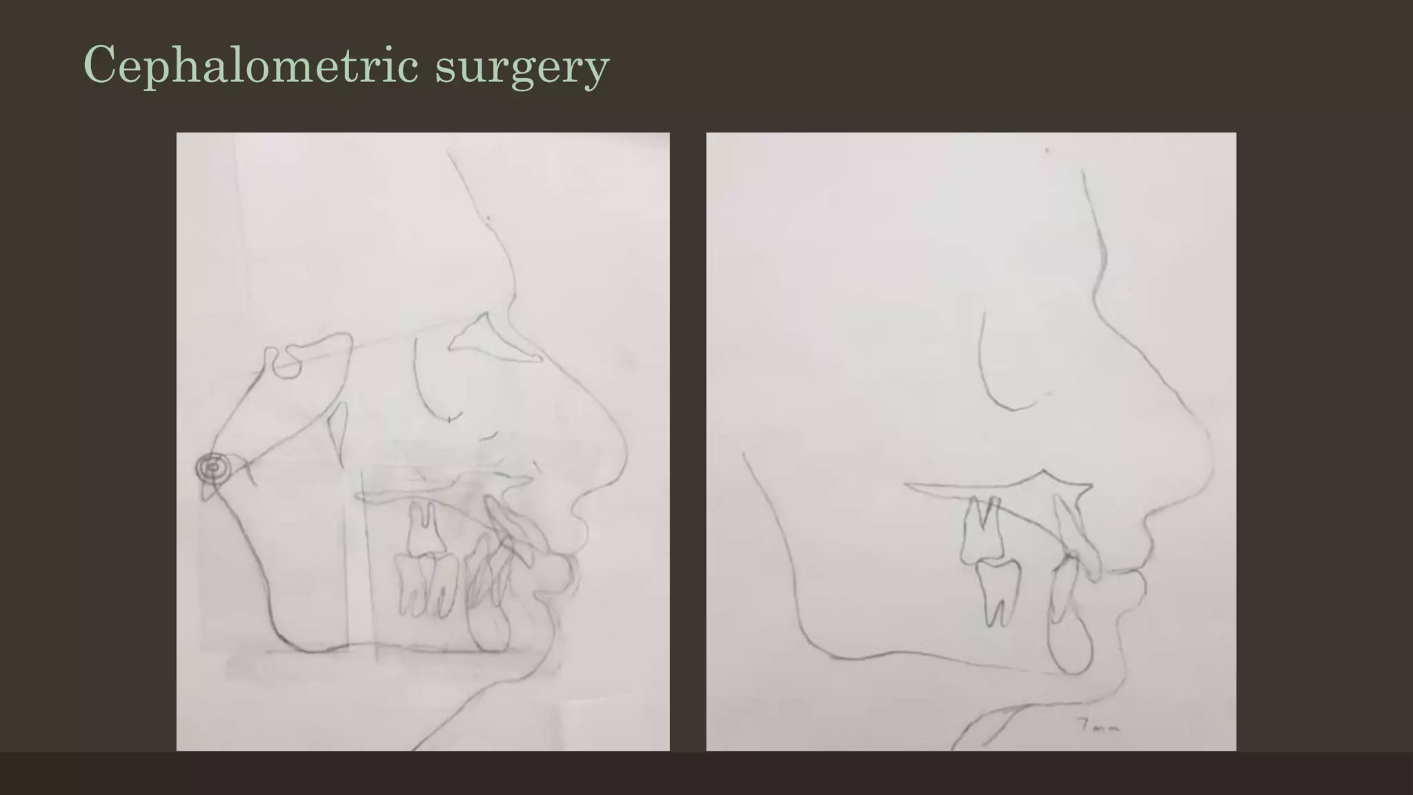Cephalometric surgery
 