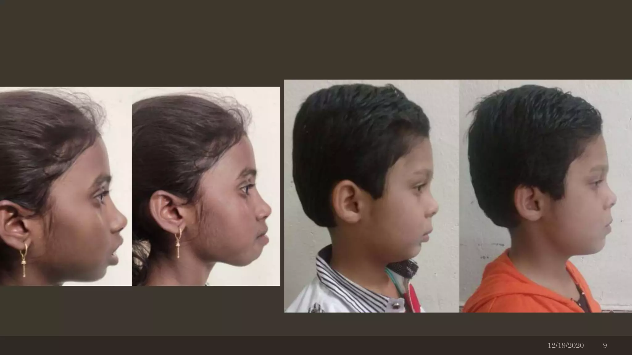 If this clinical exercise makes the facial
balance look better, the functional
appliance will probably be beneficial.
The photograph taken can be used to
motivate the patient to an achievable
treatment goal.
12/19/2020 9
 