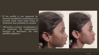 • If the profile is not improved by
forward mandibular positioning or is
actually made worse other forms of
treatment may probably be needed.
• Obviously a cursory visualization is
no substitute for cephalometric
analysis to determine the best
possible appliance.
12/19/2020 10
 