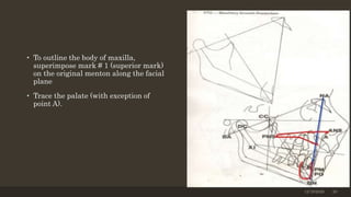 • To outline the body of maxilla,
superimpose mark # 1 (superior mark)
on the original menton along the facial
plane
• Trace the palate (with exception of
point A).
12/19/2020 20
 