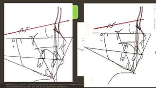 12 sequential steps
Plane of reference is Sn plane
Step 1: Copying original tracing
a) The frontonasal area
b) The sella nasion line
c) The nasion point A line
• Step 2:
A) Superimpose SN line.
B) Move the tracing to show expected
growth. Copy the sella outline.
C) copy or change facial axis.
Holdaway, R. A. (1984). A soft-tissue cephalometric analysis and its use in orthodontic treatment planning. Part II. American
Journal of Orthodontics, 85(4), 279–293. doi:10.1016/0002-9416(84)90185-4
12/19/2020 32
Holdaway’s VTO
 