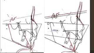 Step 3: Vertical growth of mandible
determining anterior facial height
a) Superimpose VTO tracing on SN
line.Move VTO SN line above
original SN
b) copy the anterior portion of the
mandible, including the symphysis
and anterior half of the lower border.
Also draw the soft-tissue chin
c) Copy the Downs mandibular plane
Step 4 : Anteroposterior growth of
mandible, determining the posterior
border
a) superimpose on the mandibular
plane and move the VT0 forward
until the original sella and the VT0
sella are in a vertical relation.
b) with the tracing in this position, copy
the gonial angle, the posterior
border, and the ramus.
c) superimpose on sella to complete the
condyle.
12/19/2020 33
 