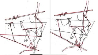 • Step 5: Maxilla and Lower nose
a) Superimpose the VTO NA line on the
original NA line and move the VTO up
until 40% of the total growth is
expressed above the SN line and 60%
below the mandible.
b) With the tracing in this position, copy
the maxilla to include the posterior
two thirds of the hard palate, PNS to
ANS to 3 mm below ANS.
c) with the tracing in this same position,
complete the nose outline around the
tip to the middle of the inferior surface.
• Step 6: Occlusal Plane
a) with the VT0 still superimposed on the
line NA, move the VT0 so that vertical
growth between the maxilla and the
mandible is expressed 50% above the
maxilla and 50% below the mandible.
b) with the tracing in this position, copy
the occlusal plan.
12/19/2020 34
 