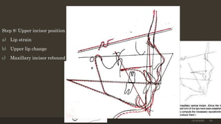 Step 8: Upper incisor position
a) Lip strain
b) Upper lip change
c) Maxillary incisor rebound
12/19/2020 36
 