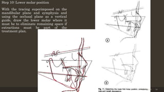 Step 10: Lower molar position
With the tracing superimposed on the
mandibular plane and symphysis and
using the occlusal plane as a vertical
guide, draw the lower molar where it
must be to eliminate remaining space if
extractions must be part of the
treatment plan.
12/19/2020 38
 
