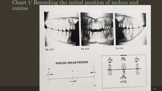 Chart 1: Recording the initial position of molars and
canine
12/19/2020 56
 