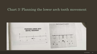 Chart 3: Planning the lower arch tooth movement
12/19/2020 58
 