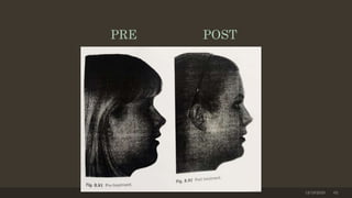 12/19/2020 62
PRE POST
 