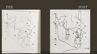 PRE POST
12/19/2020 63
 