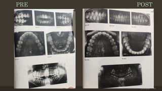 12/19/2020 64
PRE POST
 