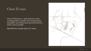 Class II case
Class II Division 1 malocclusion with
normognathic maxilla and retrognathic
mandible and horizontal growth pattern
with convex profile
Mandibular length short by 5mm.
12/19/2020 68
 