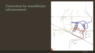 Correction by mandibular
advancement
12/19/2020 70
 