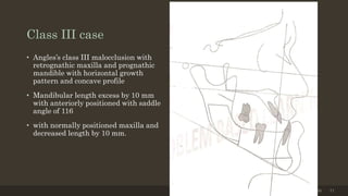 Class III case
• Angles’s class III malocclusion with
retrognathic maxilla and prognathic
mandible with horizontal growth
pattern and concave profile
• Mandibular length excess by 10 mm
with anteriorly positioned with saddle
angle of 116
• with normally positioned maxilla and
decreased length by 10 mm.
12/19/2020 71
 