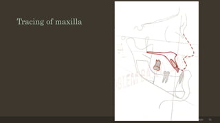 Tracing of maxilla
12/19/2020 72
 