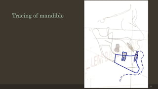 Tracing of mandible
12/19/2020 73
 