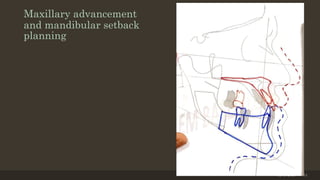 Maxillary advancement
and mandibular setback
planning
12/19/2020 74
 