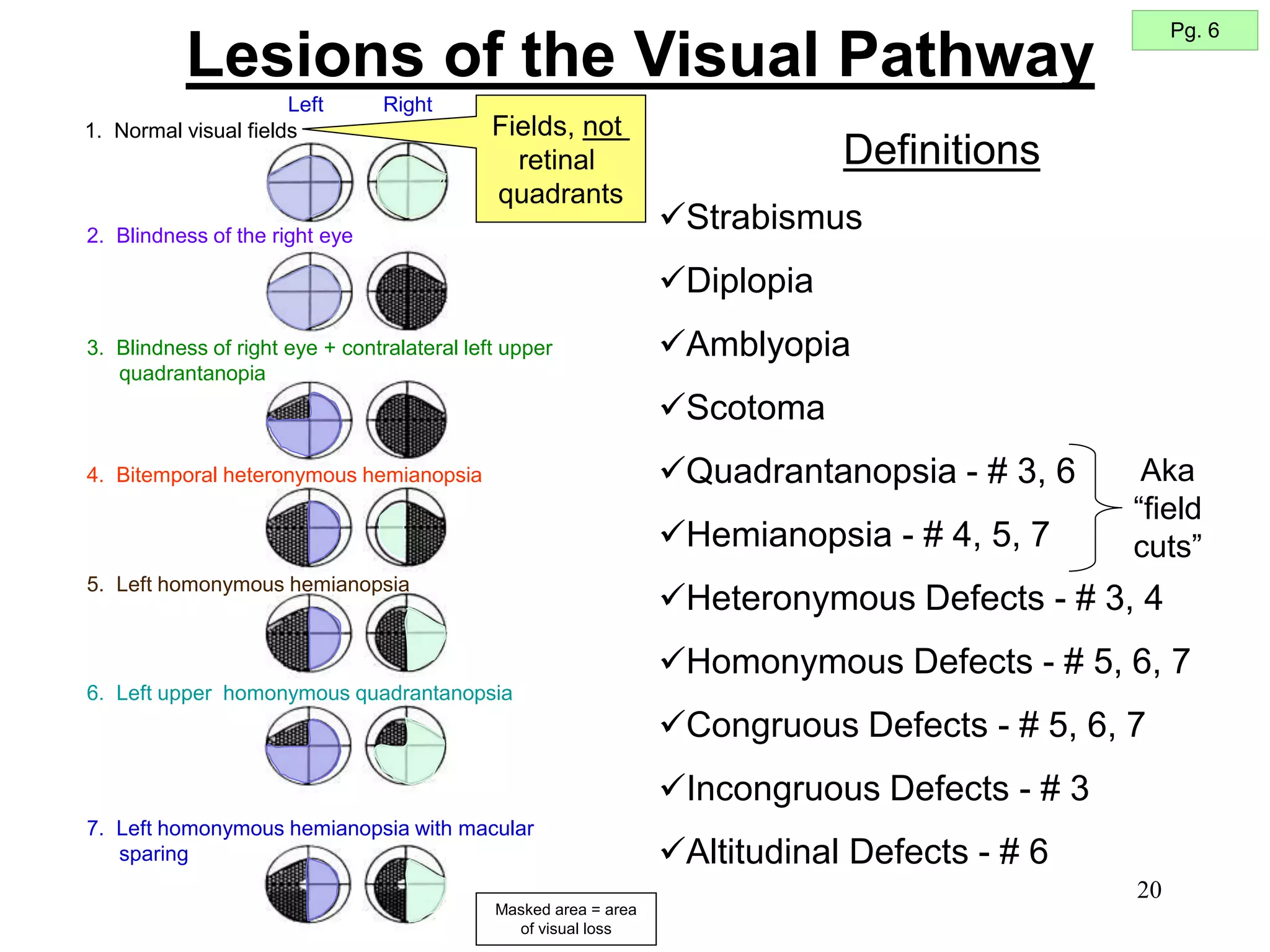 20
Lesions of the Visual Pathway
1. Normal visual fields
2. Blindness of the right eye
3. Blindness of right eye + contralateral left upper
quadrantanopia
4. Bitemporal heteronymous hemianopsia
5. Left homonymous hemianopsia
6. Left upper homonymous quadrantanopsia
7. Left homonymous hemianopsia with macular
sparing
Right
Left
Definitions
Strabismus
Diplopia
Amblyopia
Scotoma
Quadrantanopsia - # 3, 6
Hemianopsia - # 4, 5, 7
Heteronymous Defects - # 3, 4
Homonymous Defects - # 5, 6, 7
Congruous Defects - # 5, 6, 7
Incongruous Defects - # 3
Altitudinal Defects - # 6
Masked area = area
of visual loss
Pg. 6
Aka
“field
cuts”
Fields, not
retinal
quadrants
 