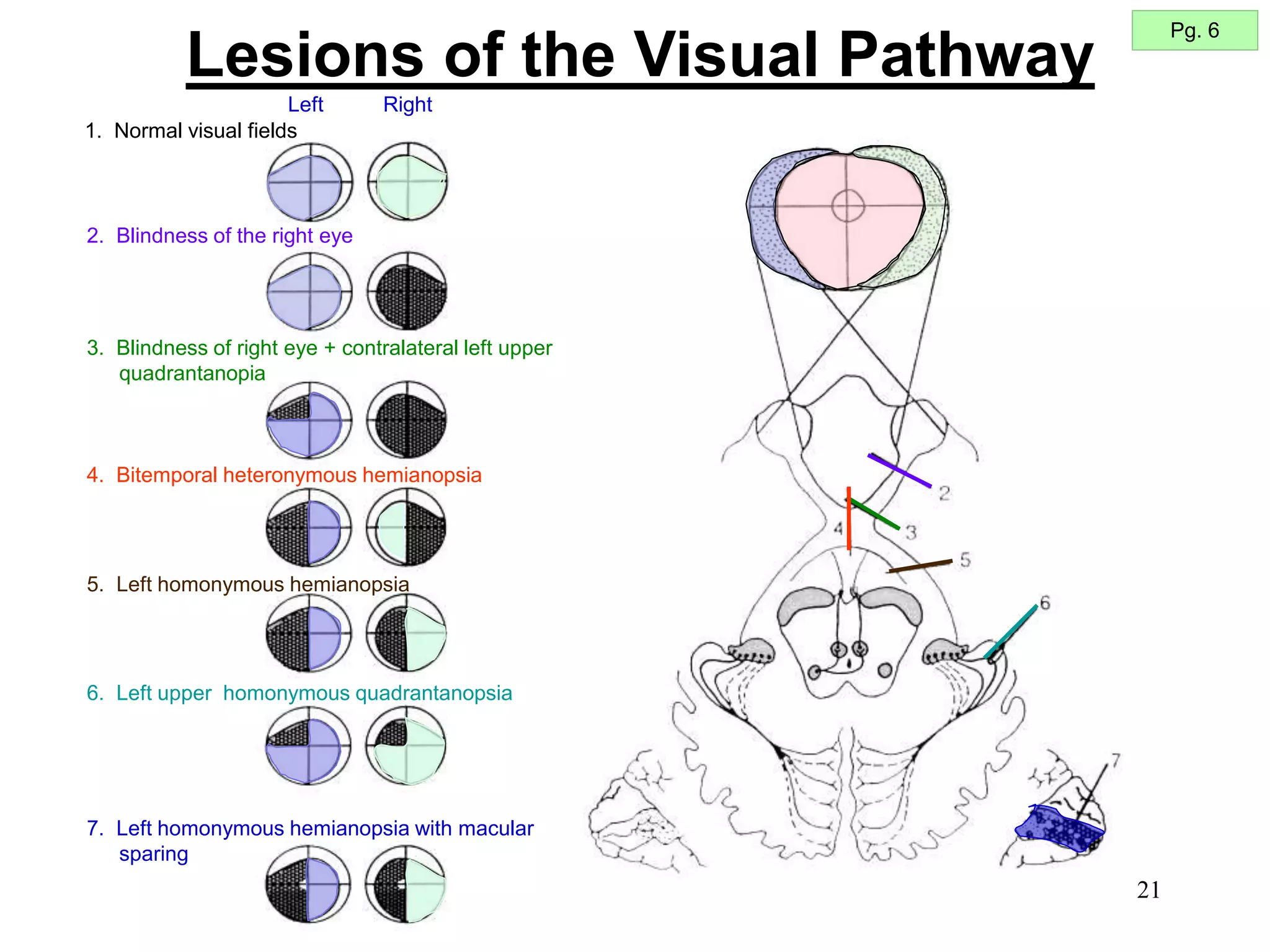 21
Lesions of the Visual Pathway
1. Normal visual fields
2. Blindness of the right eye
3. Blindness of right eye + contralateral left upper
quadrantanopia
4. Bitemporal heteronymous hemianopsia
5. Left homonymous hemianopsia
6. Left upper homonymous quadrantanopsia
7. Left homonymous hemianopsia with macular
sparing
Right
Left
Pg. 6
 