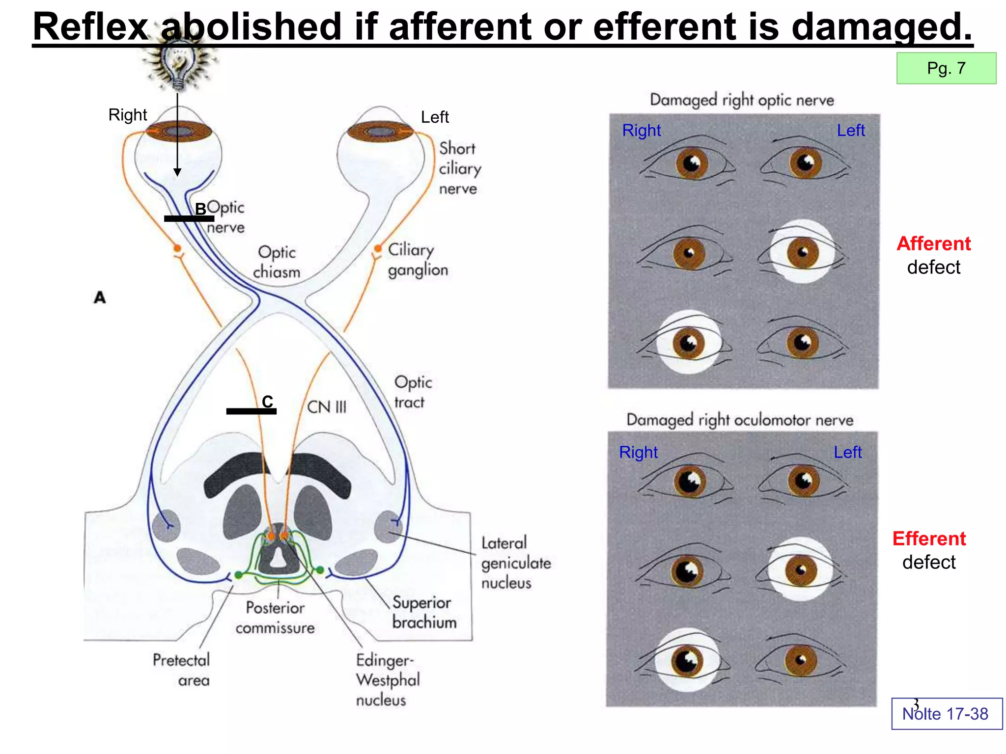 23
Right Left
B
C
Right Left
Right Left
Nolte 17-38
Reflex abolished if afferent or efferent is damaged.
Pg. 7
Afferent
defect
Efferent
defect
 