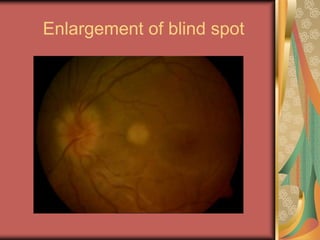 Enlargement of blind spot
 