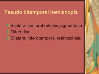 Pseudo bitemporal hemianopia

  Bilateral sectoral retinitis pigmentosa
  Tilted disc
  Bilateral inferotemporal retinoschsis.
 