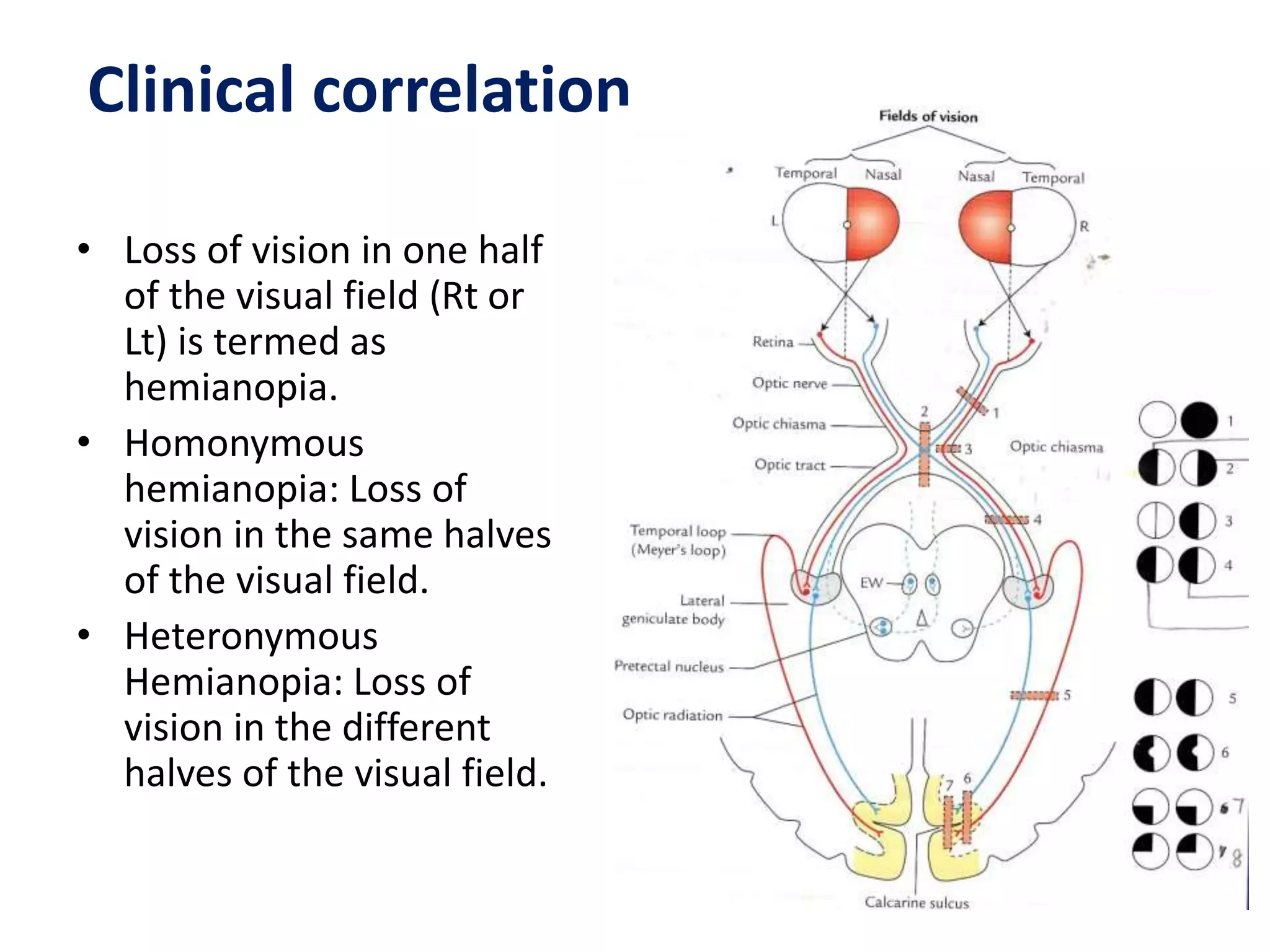 Clinical correlation
• Loss of vision in one half
of the visual field (Rt or
Lt) is termed as
hemianopia.
• Homonymous
hemianopia: Loss of
vision in the same halves
of the visual field.
• Heteronymous
Hemianopia: Loss of
vision in the different
halves of the visual field.
 