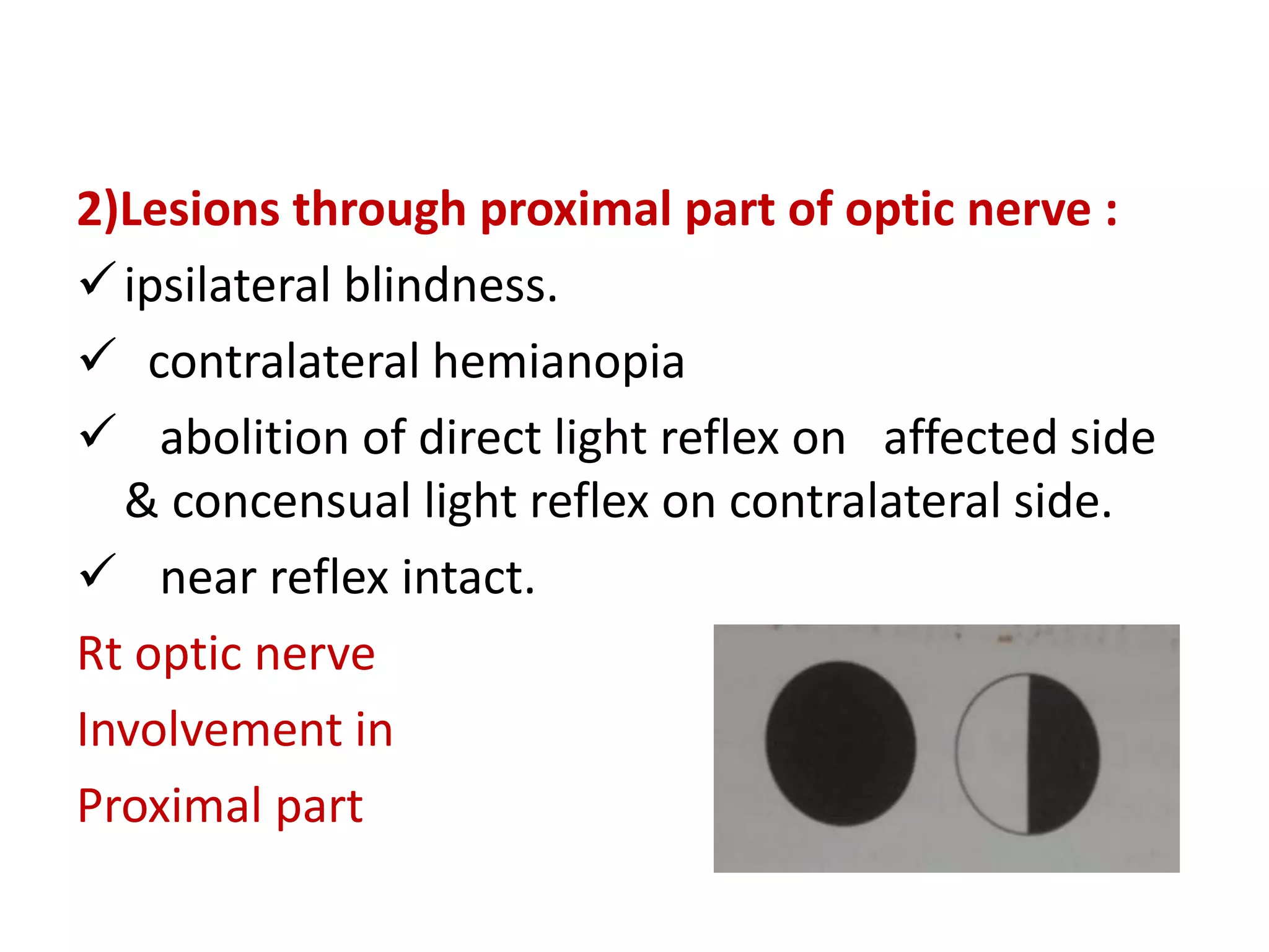 2)Lesions through proximal part of optic nerve :
ipsilateral blindness.
 contralateral hemianopia
 abolition of direct light reflex on affected side
& concensual light reflex on contralateral side.
 near reflex intact.
Rt optic nerve
Involvement in
Proximal part
 