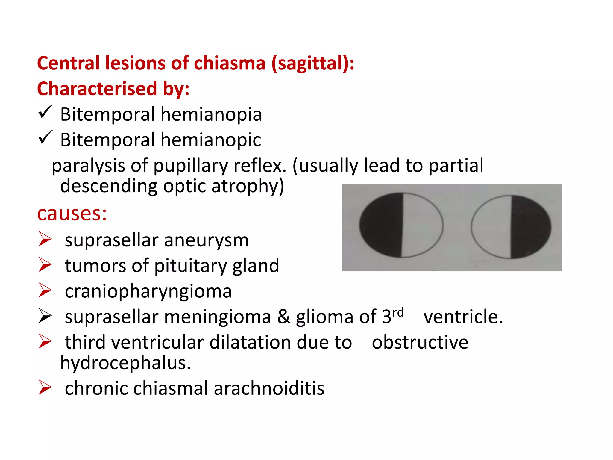 Central lesions of chiasma (sagittal):
Characterised by:
 Bitemporal hemianopia
 Bitemporal hemianopic
paralysis of pupillary reflex. (usually lead to partial
descending optic atrophy)
causes:
 suprasellar aneurysm
 tumors of pituitary gland
 craniopharyngioma
 suprasellar meningioma & glioma of 3rd ventricle.
 third ventricular dilatation due to obstructive
hydrocephalus.
 chronic chiasmal arachnoiditis
 