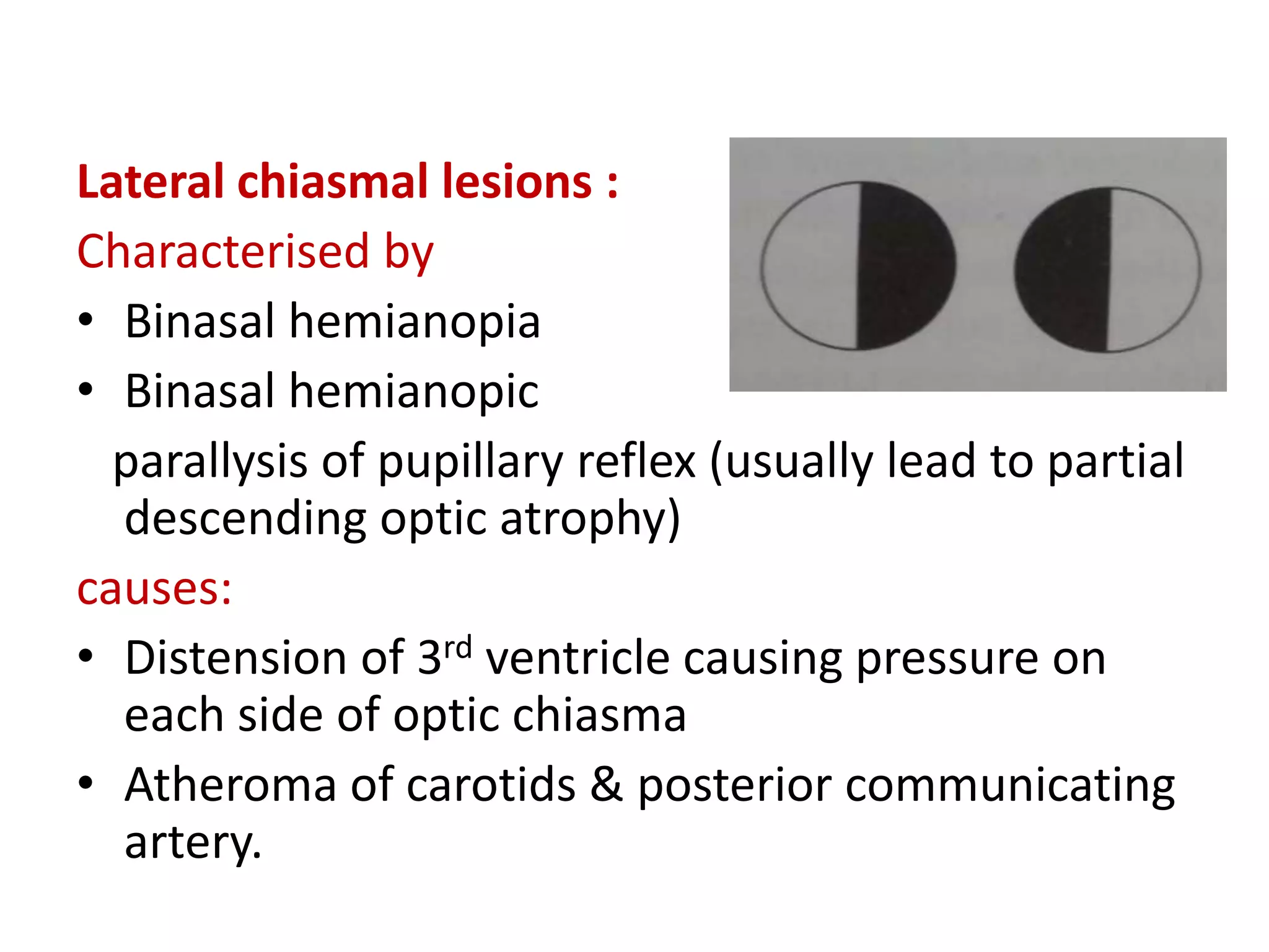 Lateral chiasmal lesions :
Characterised by
• Binasal hemianopia
• Binasal hemianopic
parallysis of pupillary reflex (usually lead to partial
descending optic atrophy)
causes:
• Distension of 3rd ventricle causing pressure on
each side of optic chiasma
• Atheroma of carotids & posterior communicating
artery.
 