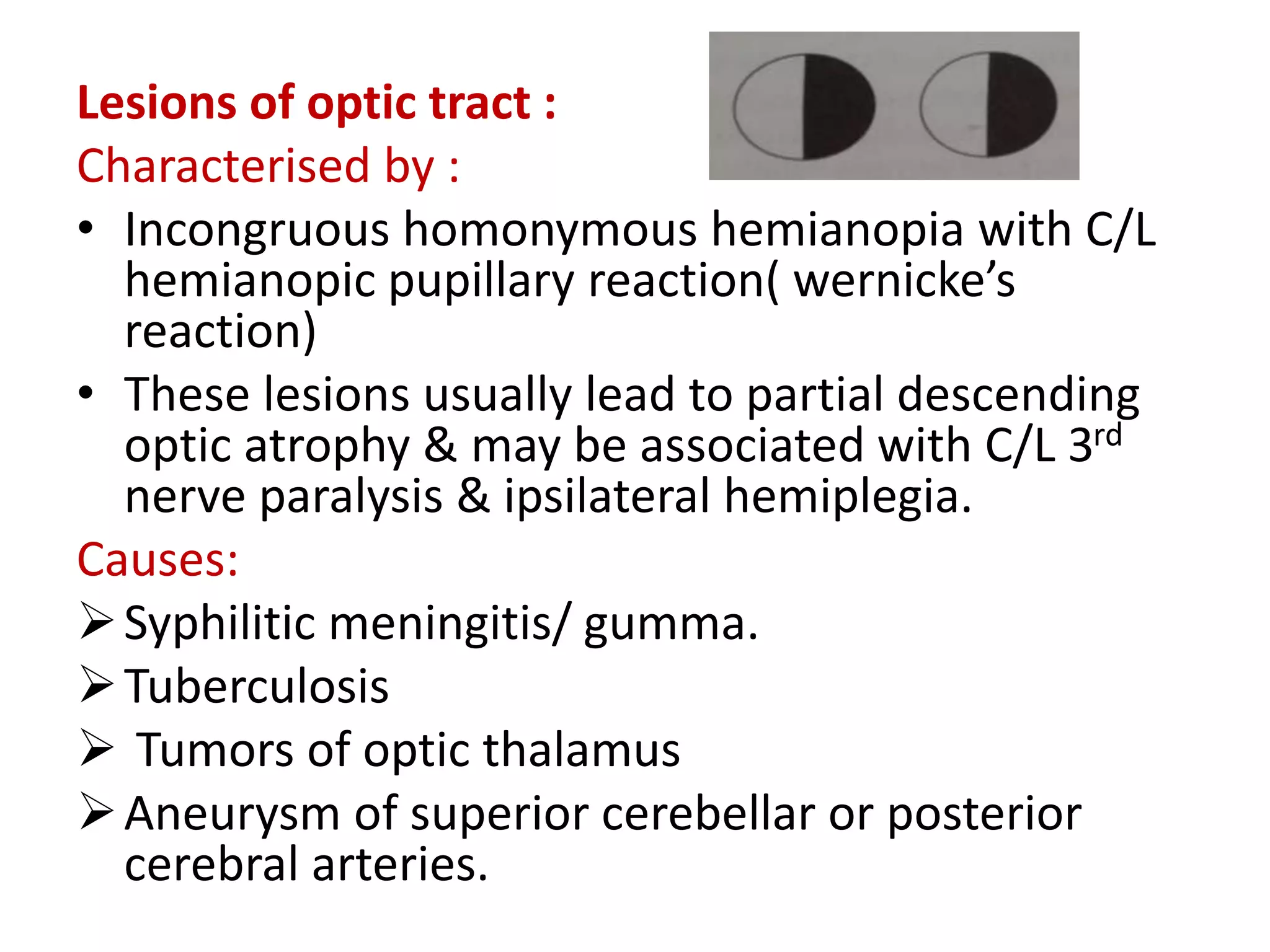Lesions of optic tract :
Characterised by :
• Incongruous homonymous hemianopia with C/L
hemianopic pupillary reaction( wernicke’s
reaction)
• These lesions usually lead to partial descending
optic atrophy & may be associated with C/L 3rd
nerve paralysis & ipsilateral hemiplegia.
Causes:
Syphilitic meningitis/ gumma.
Tuberculosis
 Tumors of optic thalamus
Aneurysm of superior cerebellar or posterior
cerebral arteries.
 