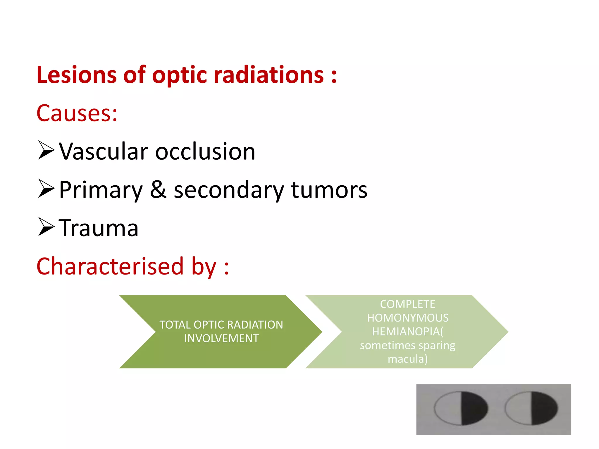 Lesions of optic radiations :
Causes:
Vascular occlusion
Primary & secondary tumors
Trauma
Characterised by :
TOTAL OPTIC RADIATION
INVOLVEMENT
COMPLETE
HOMONYMOUS
HEMIANOPIA(
sometimes sparing
macula)
 
