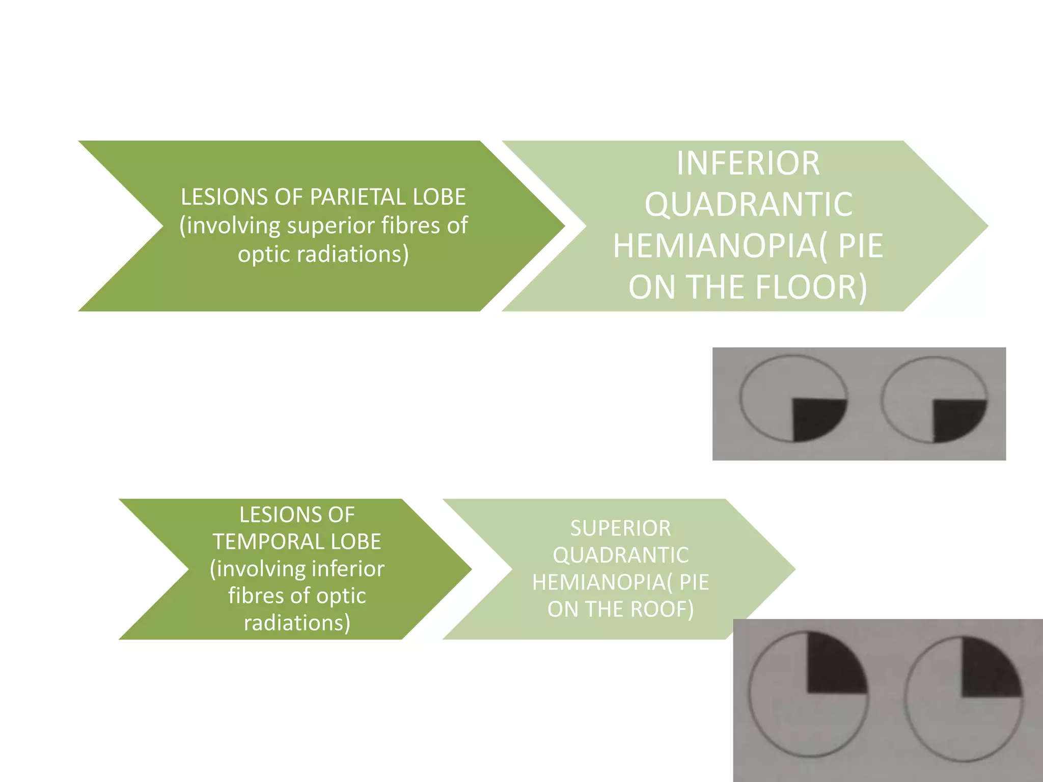 LESIONS OF PARIETAL LOBE
(involving superior fibres of
optic radiations)
INFERIOR
QUADRANTIC
HEMIANOPIA( PIE
ON THE FLOOR)
LESIONS OF
TEMPORAL LOBE
(involving inferior
fibres of optic
radiations)
SUPERIOR
QUADRANTIC
HEMIANOPIA( PIE
ON THE ROOF)
 