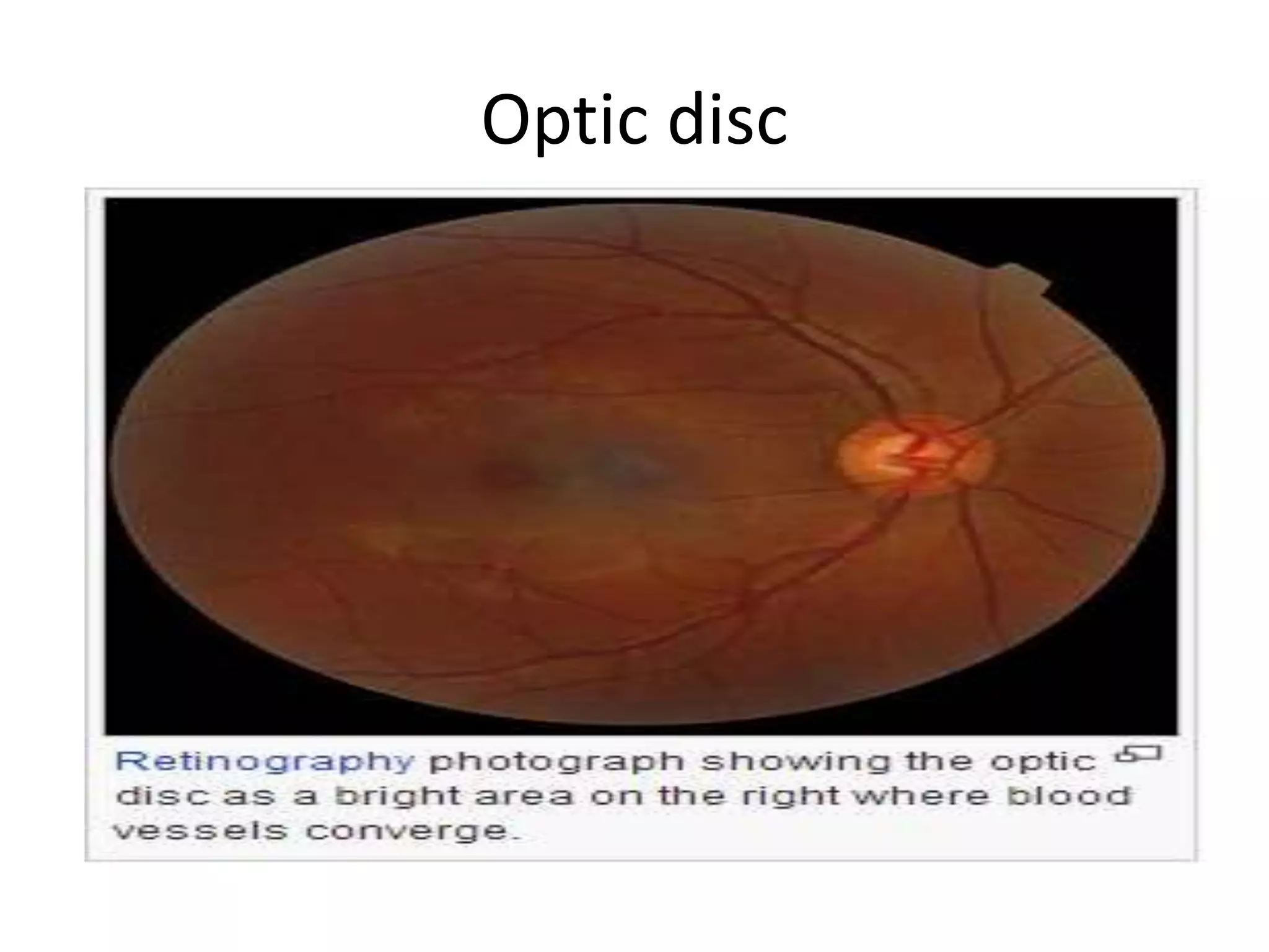 Optic disc
 
