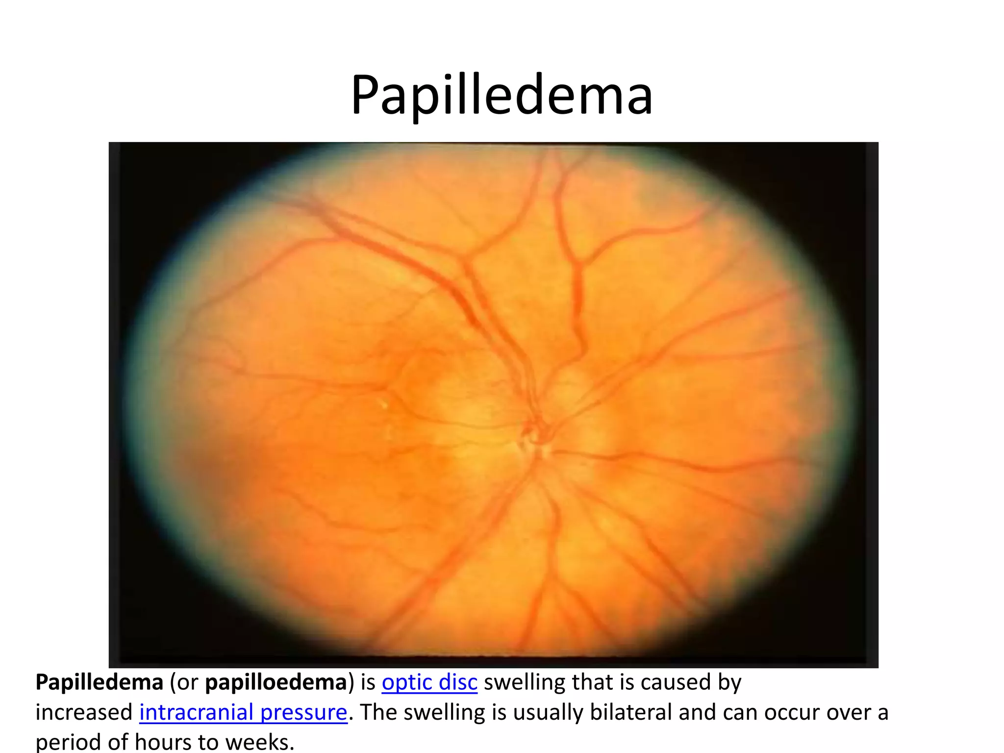 Papilledema
Papilledema (or papilloedema) is optic disc swelling that is caused by
increased intracranial pressure. The swelling is usually bilateral and can occur over a
period of hours to weeks.
 
