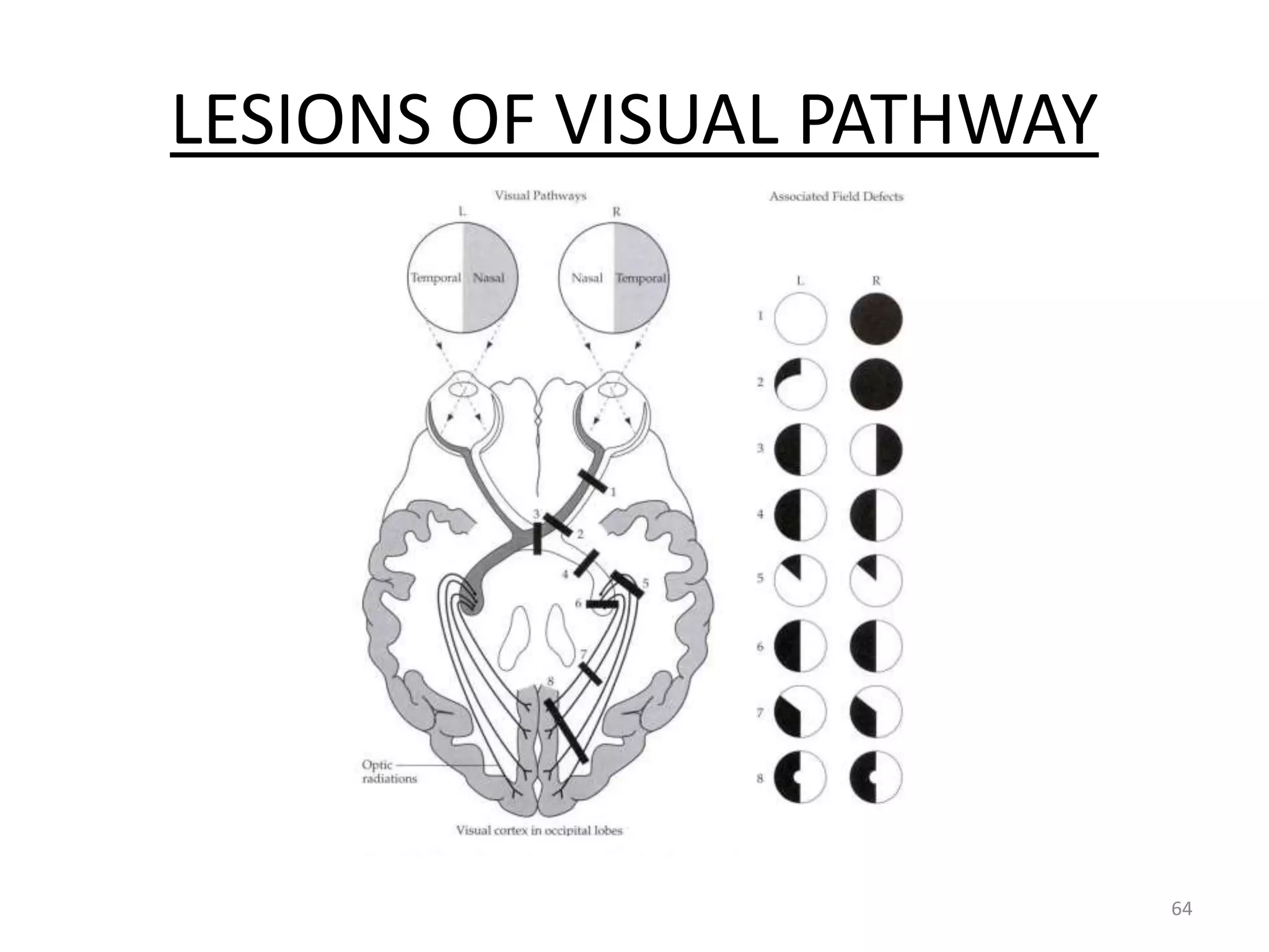 LESIONS OF VISUAL PATHWAY
64
 