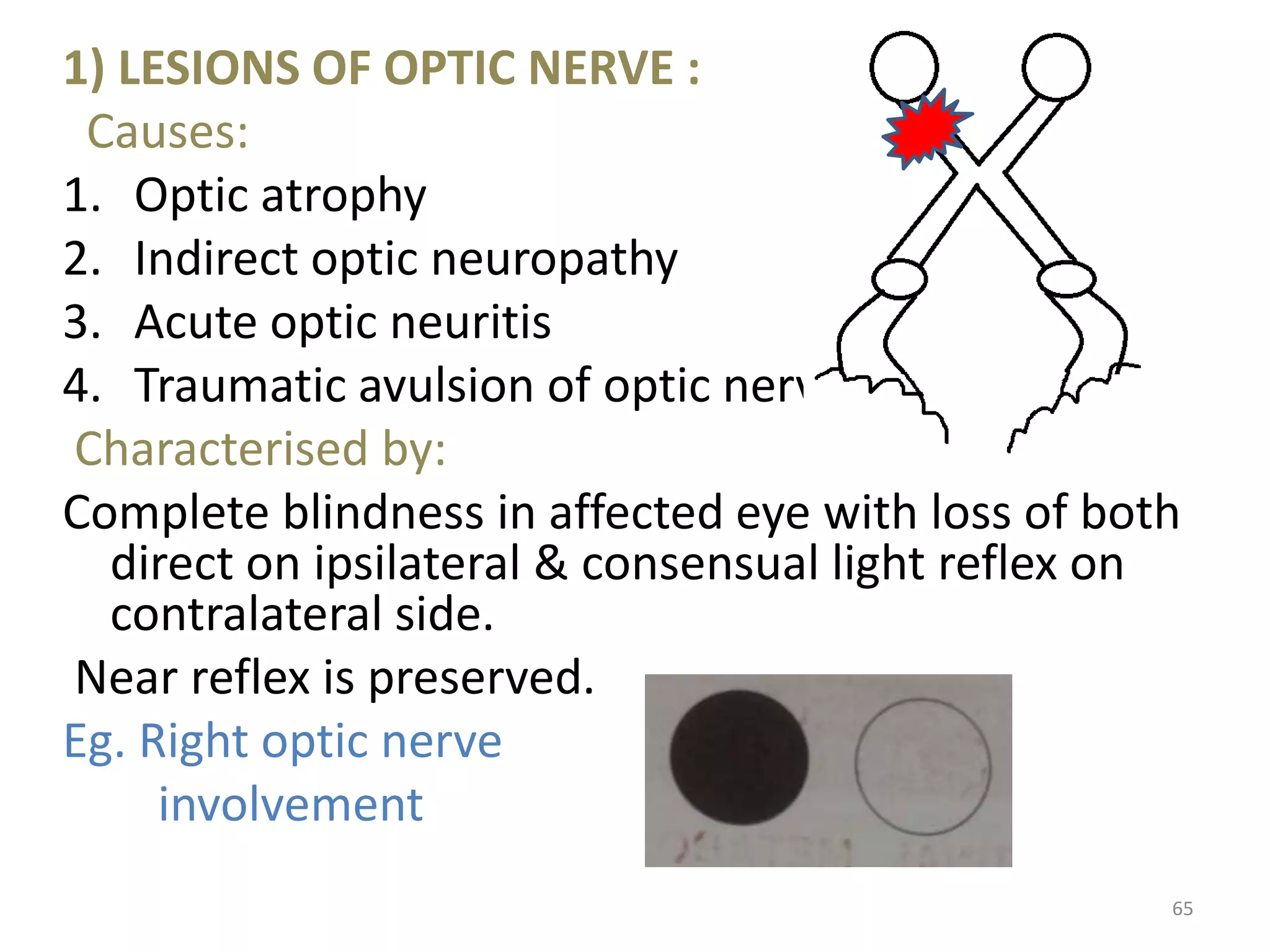 1) LESIONS OF OPTIC NERVE :
Causes:
1. Optic atrophy
2. Indirect optic neuropathy
3. Acute optic neuritis
4. Traumatic avulsion of optic nerve.
Characterised by:
Complete blindness in affected eye with loss of both
direct on ipsilateral & consensual light reflex on
contralateral side.
Near reflex is preserved.
Eg. Right optic nerve
involvement
65
 