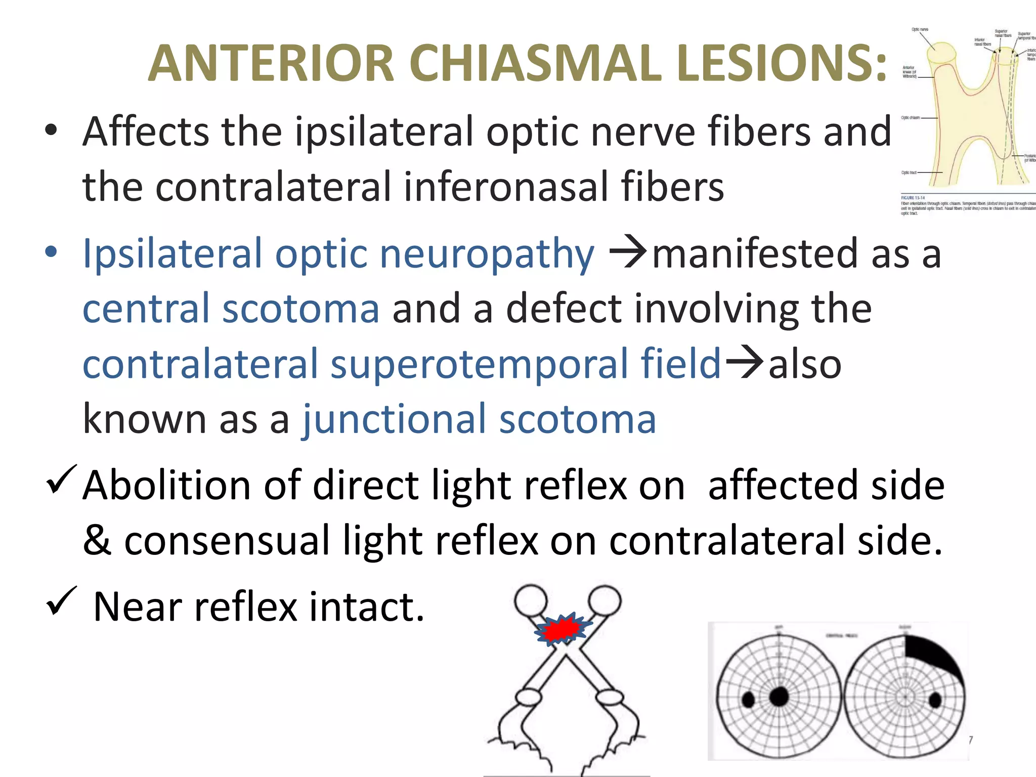 ANTERIOR CHIASMAL LESIONS:
67
• Affects the ipsilateral optic nerve fibers and
the contralateral inferonasal fibers
• Ipsilateral optic neuropathy manifested as a
central scotoma and a defect involving the
contralateral superotemporal fieldalso
known as a junctional scotoma
Abolition of direct light reflex on affected side
& consensual light reflex on contralateral side.
 Near reflex intact.
 