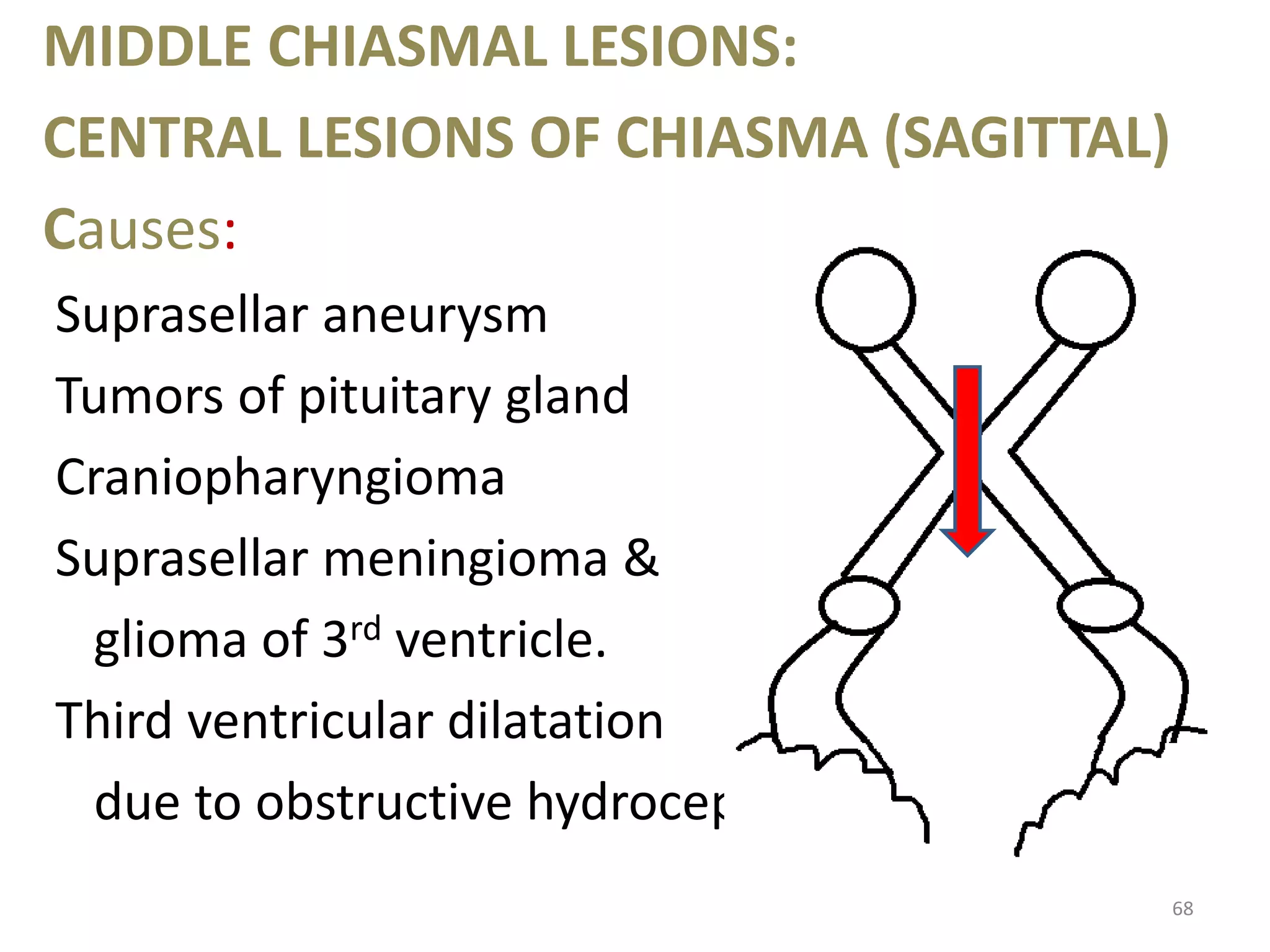 MIDDLE CHIASMAL LESIONS:
CENTRAL LESIONS OF CHIASMA (SAGITTAL)
Causes:
Suprasellar aneurysm
Tumors of pituitary gland
Craniopharyngioma
Suprasellar meningioma &
glioma of 3rd ventricle.
Third ventricular dilatation
due to obstructive hydrocephalus.
68
 