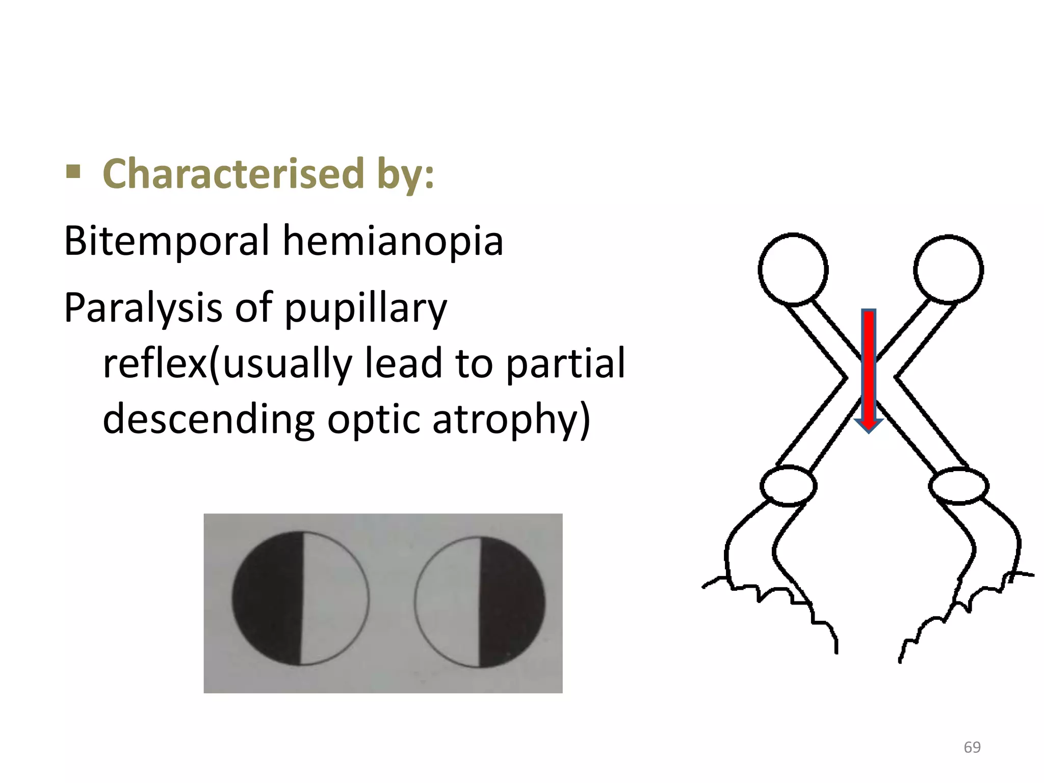 69
 Characterised by:
Bitemporal hemianopia
Paralysis of pupillary
reflex(usually lead to partial
descending optic atrophy)
 