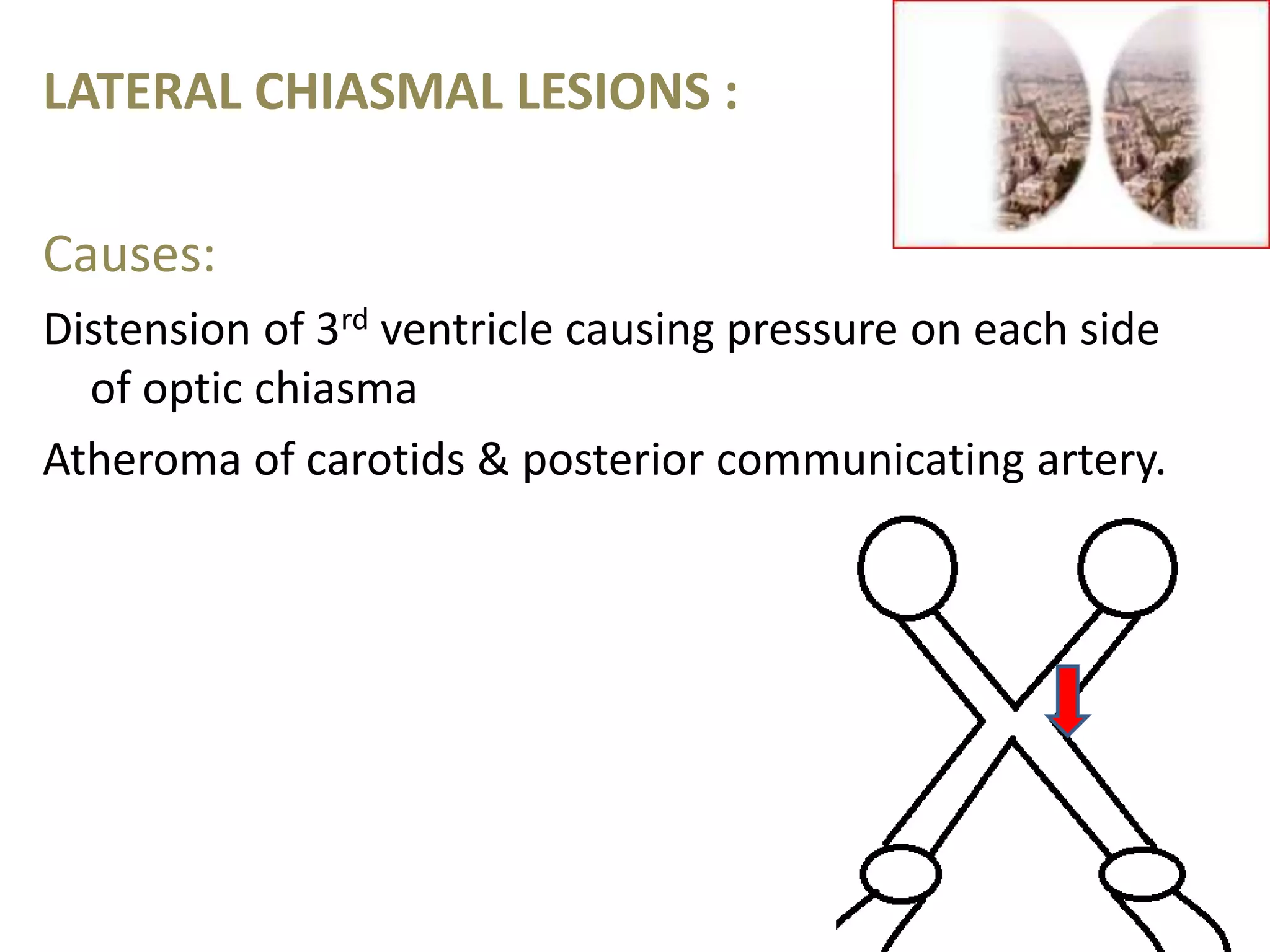 LATERAL CHIASMAL LESIONS :
Causes:
Distension of 3rd ventricle causing pressure on each side
of optic chiasma
Atheroma of carotids & posterior communicating artery.
70
 