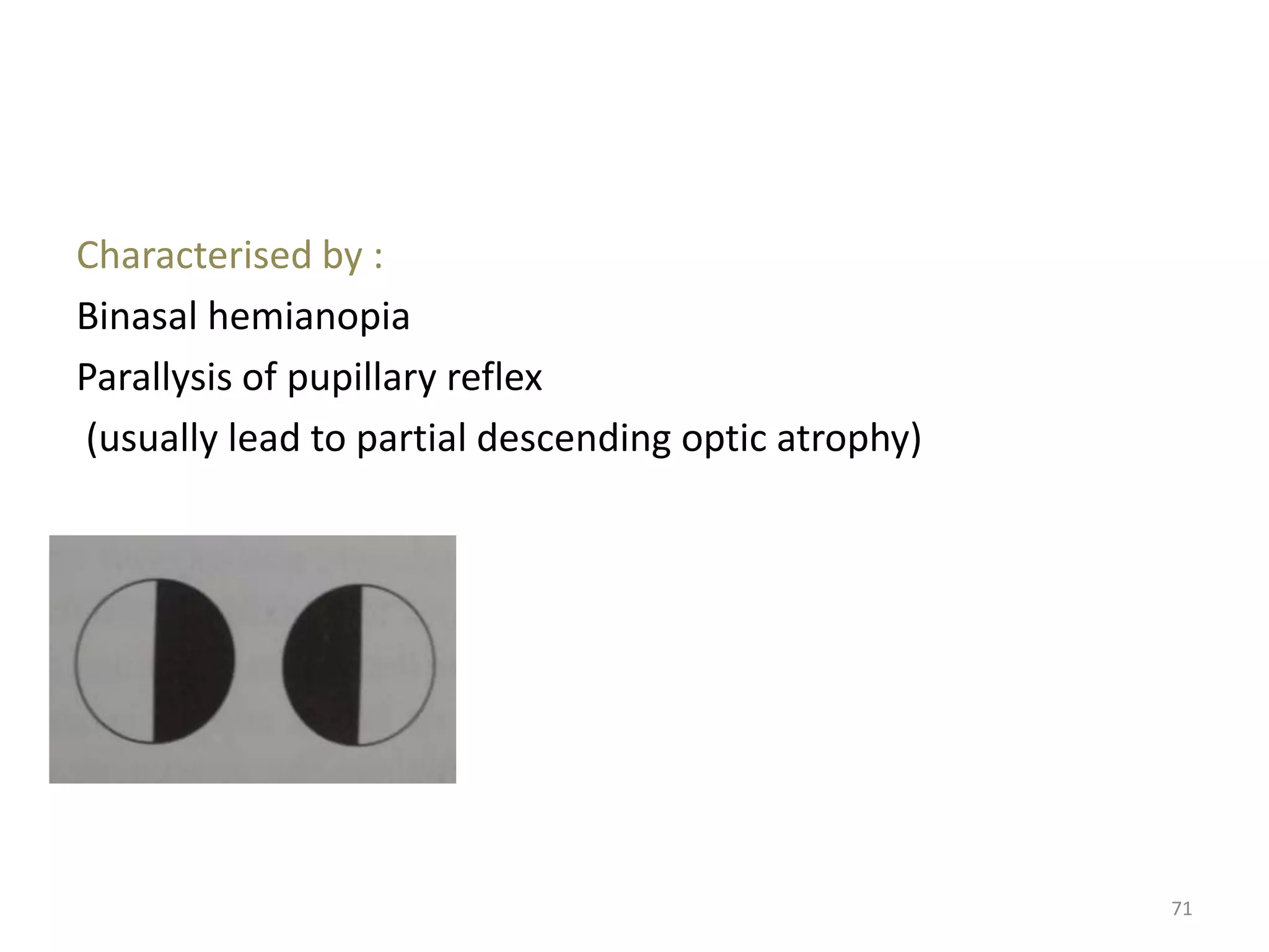 71
Characterised by :
Binasal hemianopia
Parallysis of pupillary reflex
(usually lead to partial descending optic atrophy)
 