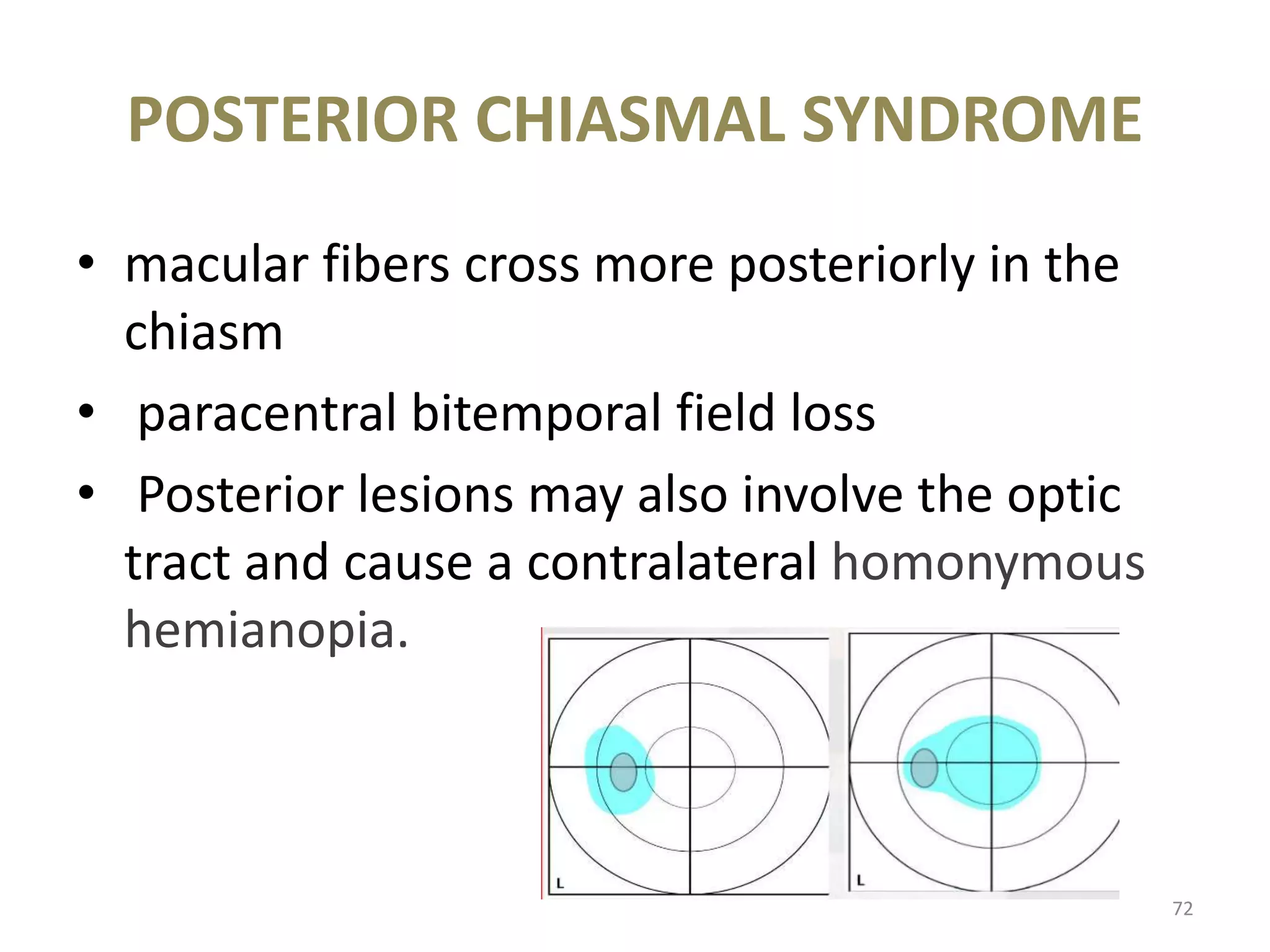 POSTERIOR CHIASMAL SYNDROME
72
• macular fibers cross more posteriorly in the
chiasm
• paracentral bitemporal field loss
• Posterior lesions may also involve the optic
tract and cause a contralateral homonymous
hemianopia.
 