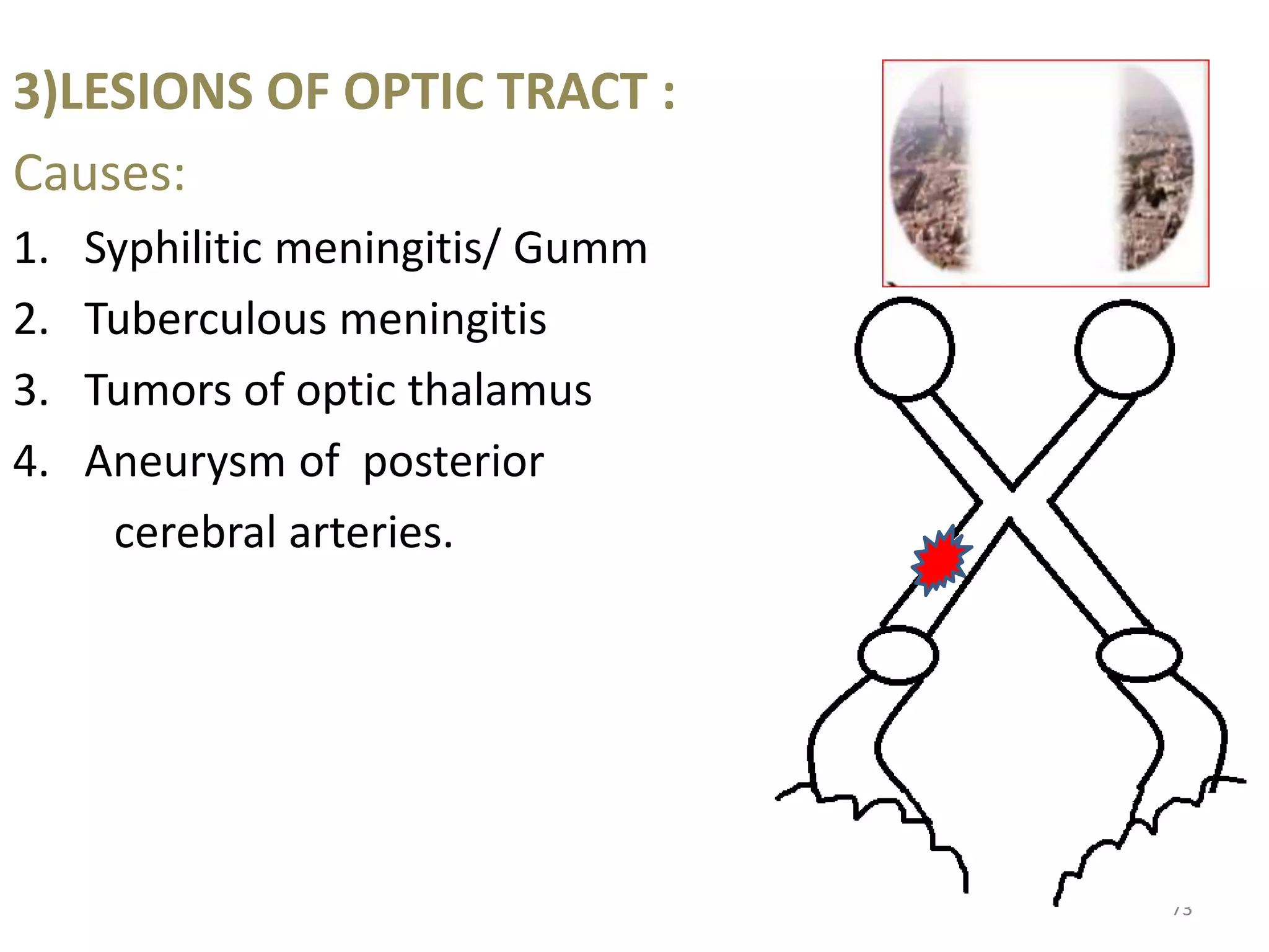 3)LESIONS OF OPTIC TRACT :
Causes:
1. Syphilitic meningitis/ Gumm
2. Tuberculous meningitis
3. Tumors of optic thalamus
4. Aneurysm of posterior
cerebral arteries.
73
 