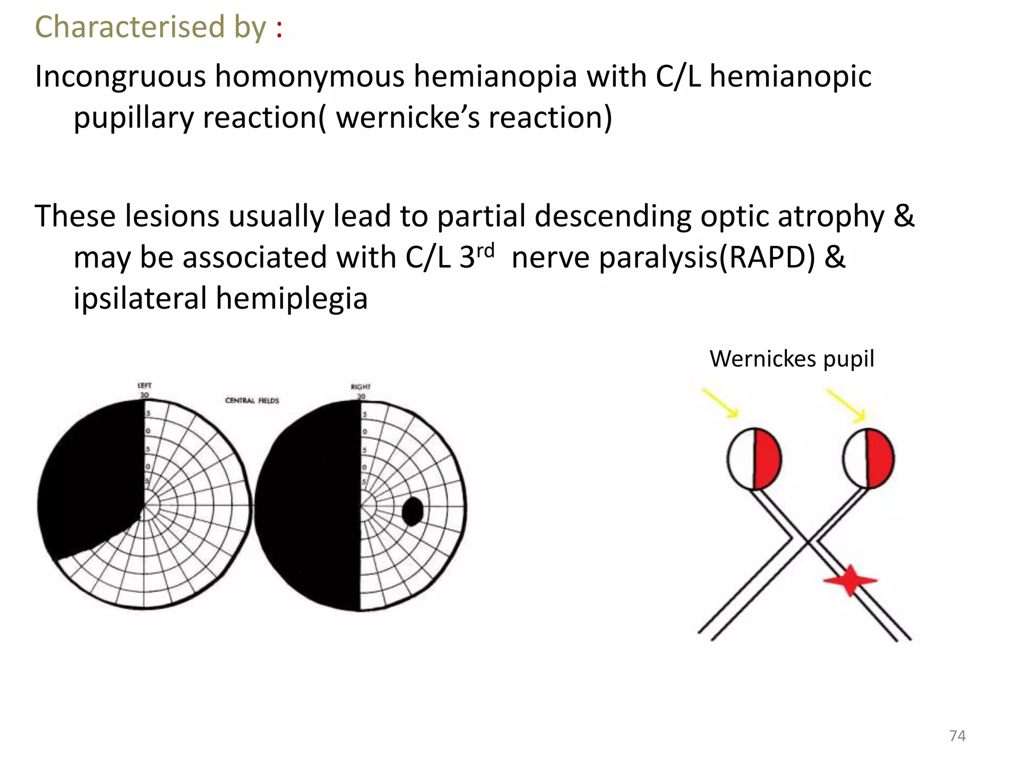 74
Characterised by :
Incongruous homonymous hemianopia with C/L hemianopic
pupillary reaction( wernicke’s reaction)
These lesions usually lead to partial descending optic atrophy &
may be associated with C/L 3rd nerve paralysis(RAPD) &
ipsilateral hemiplegia
Wernickes pupil
 