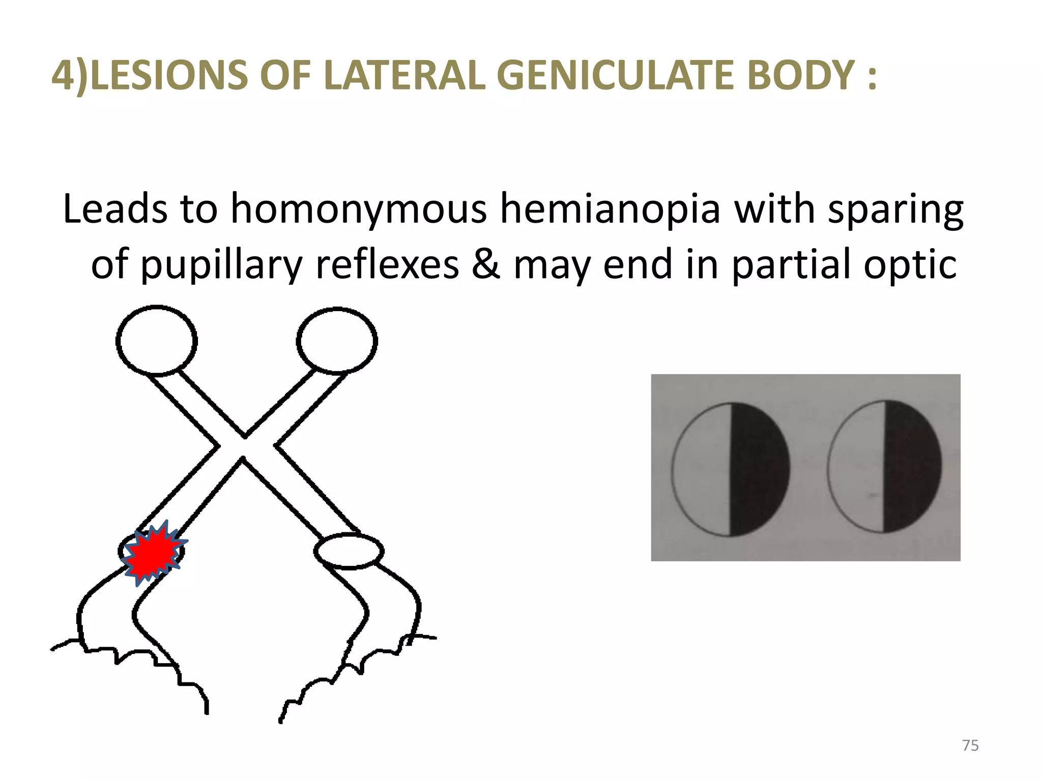 4)LESIONS OF LATERAL GENICULATE BODY :
Leads to homonymous hemianopia with sparing
of pupillary reflexes & may end in partial optic
atrophy.
75
 