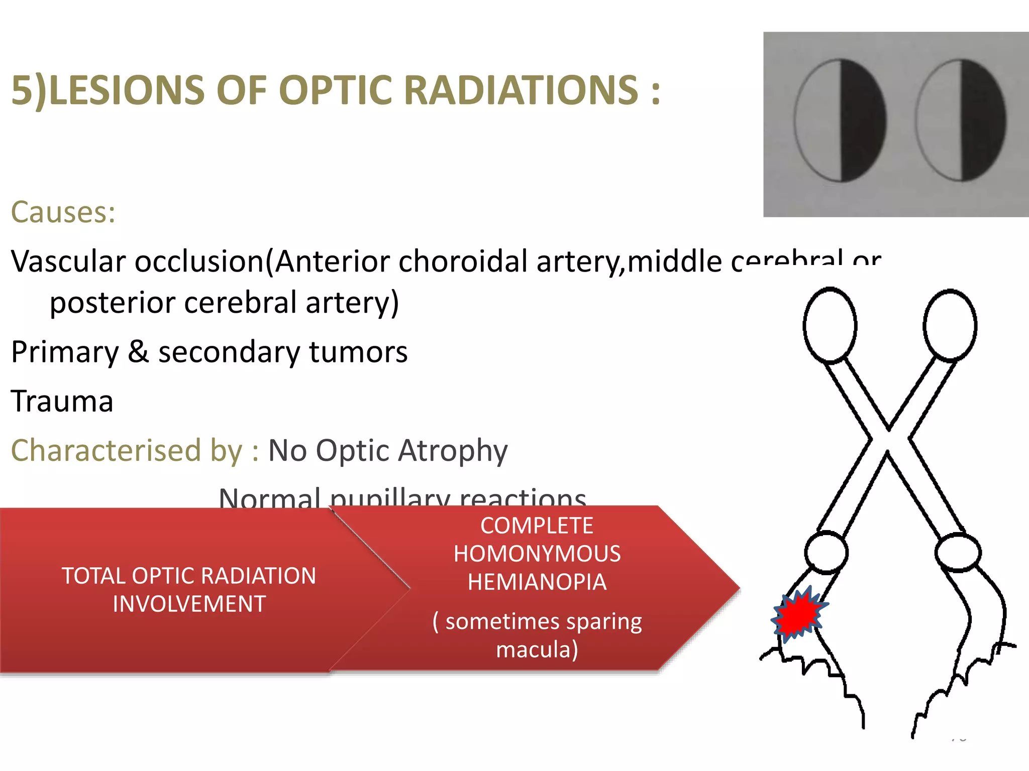 5)LESIONS OF OPTIC RADIATIONS :
Causes:
Vascular occlusion(Anterior choroidal artery,middle cerebral or
posterior cerebral artery)
Primary & secondary tumors
Trauma
Characterised by : No Optic Atrophy
Normal pupillary reactions
TOTAL OPTIC RADIATION
INVOLVEMENT
COMPLETE
HOMONYMOUS
HEMIANOPIA
( sometimes sparing
macula)
76
 