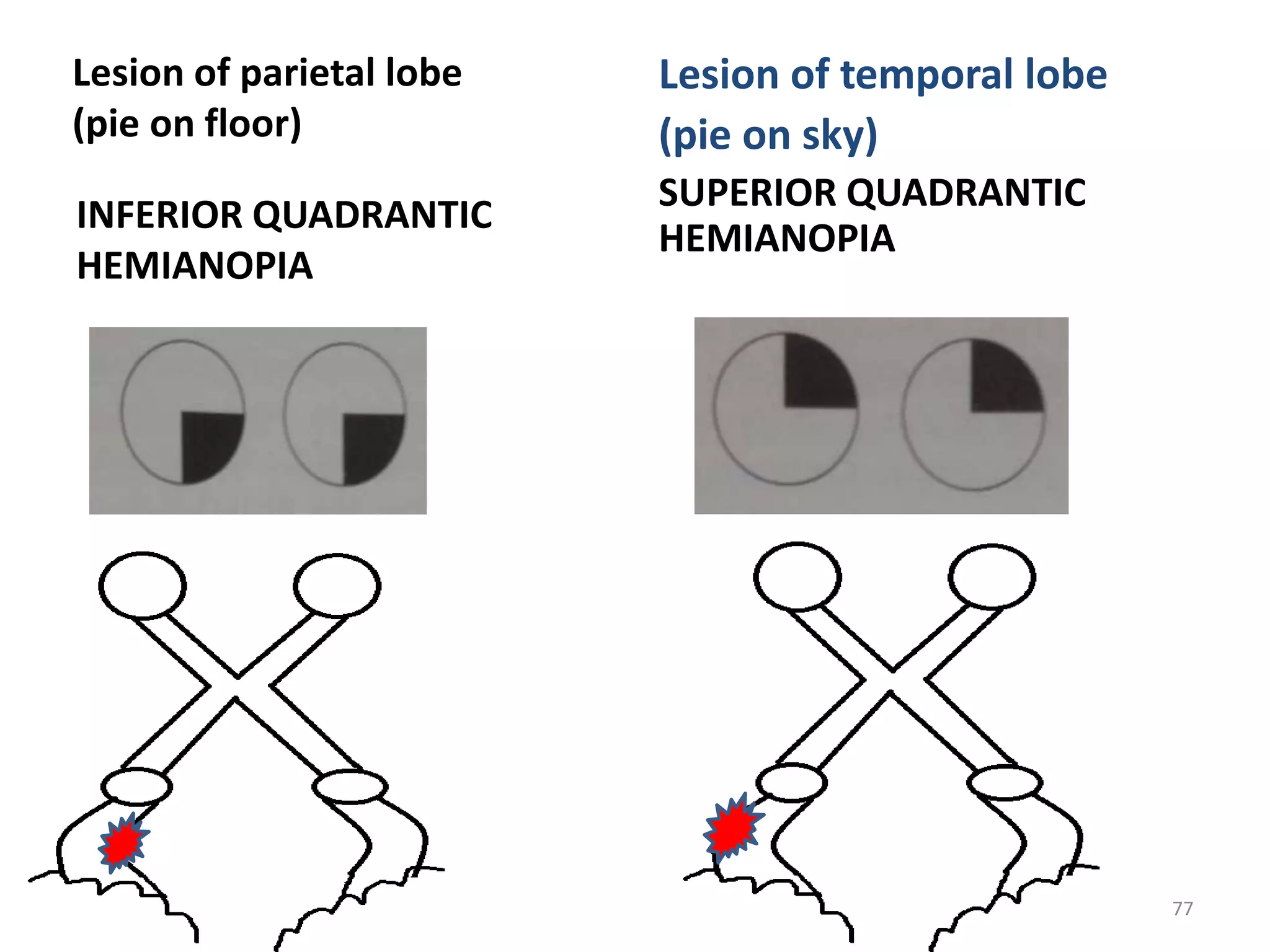 INFERIOR QUADRANTIC
HEMIANOPIA
Lesion of temporal lobe
(pie on sky)
SUPERIOR QUADRANTIC
HEMIANOPIA
77
Lesion of parietal lobe
(pie on floor)
 