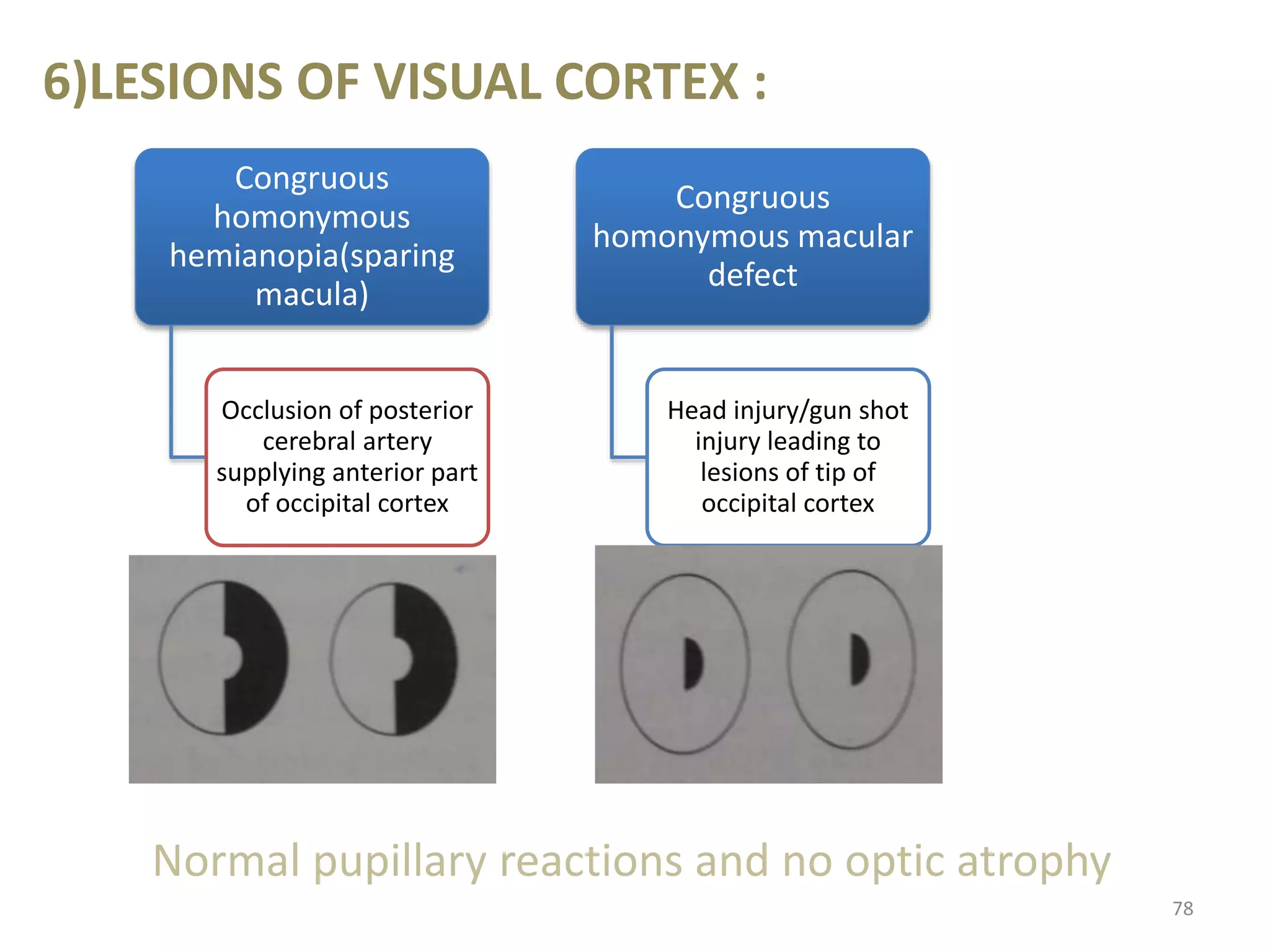 6)LESIONS OF VISUAL CORTEX :
Congruous
homonymous
hemianopia(sparing
macula)
Occlusion of posterior
cerebral artery
supplying anterior part
of occipital cortex
Congruous
homonymous macular
defect
Head injury/gun shot
injury leading to
lesions of tip of
occipital cortex
78
Normal pupillary reactions and no optic atrophy
 